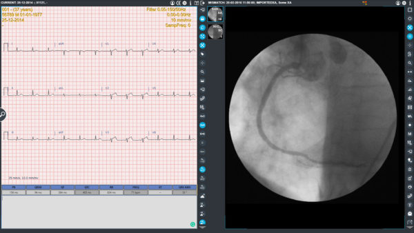 ecg_comparison